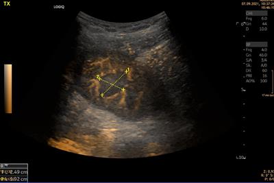 Value and limitations of sonography in kidney transplant recipients with special attention to the resistive index – An update